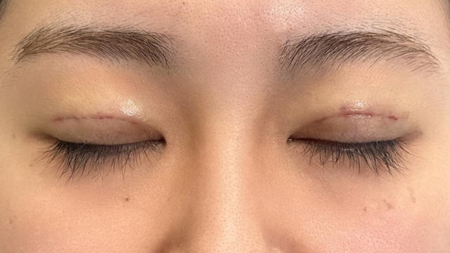 Postoperative Condition Part 1