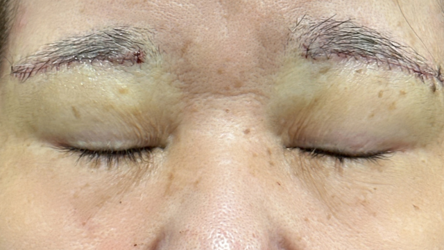 Postoperative Condition Part 1