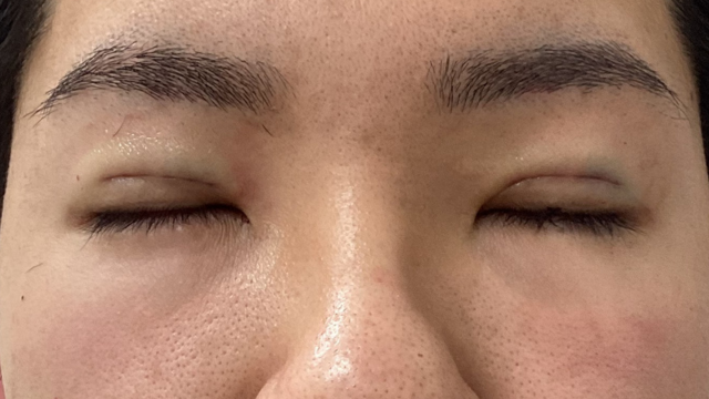 Postoperative Condition Part 1