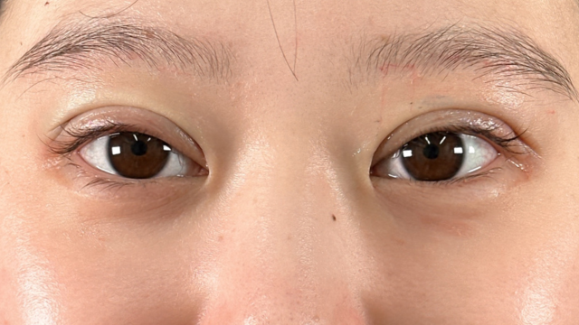 手術前の状態 その1