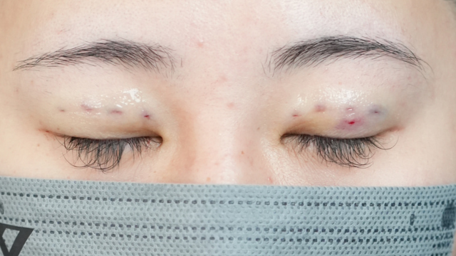 Postoperative Condition Part 1