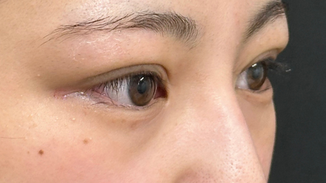 手术前的状态 其一