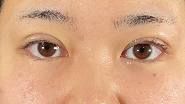 Postoperative Condition Part 1