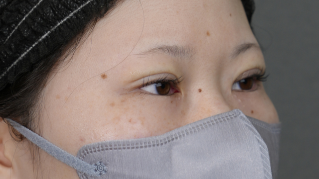 Postoperative Condition Part 1