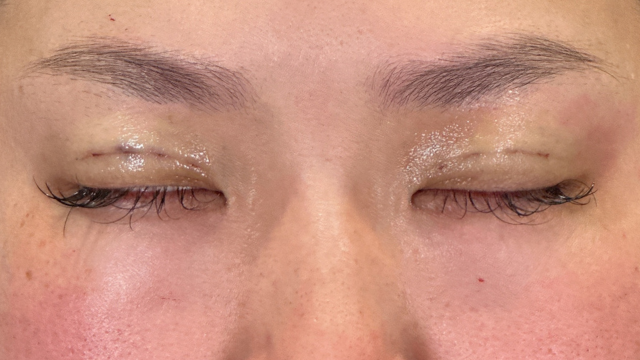 Postoperative Condition Part 1