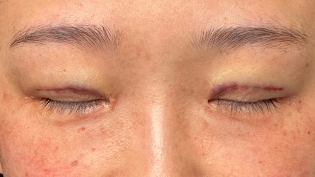 Postoperative Condition Part 1