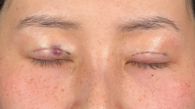 Postoperative Condition Part 1