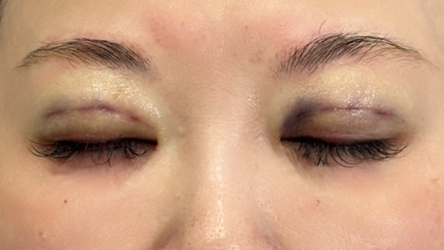 Postoperative Condition Part 1