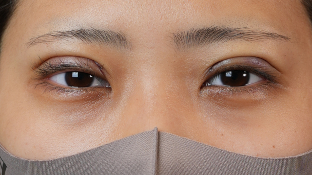 Postoperative Condition Part 1