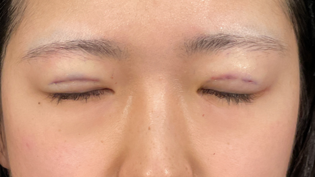 Postoperative Condition Part 1