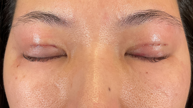 Postoperative Condition Part 1