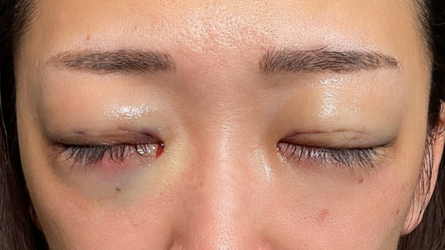 Postoperative Condition Part 1