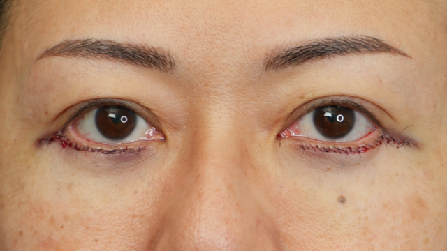 Postoperative Condition Part 1