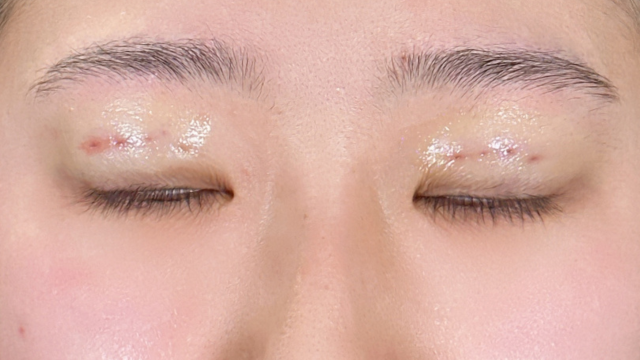 Postoperative Condition Part 1