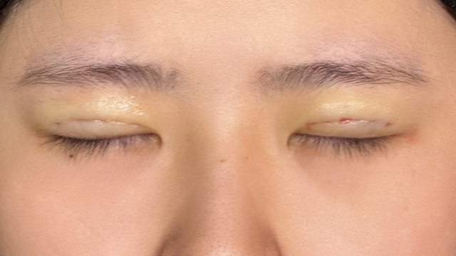 Postoperative Condition Part 1