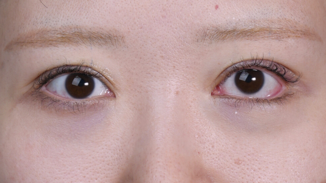 Postoperative Condition Part 1