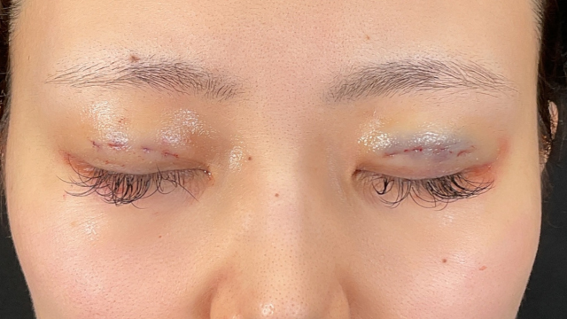 Postoperative Condition Part 1