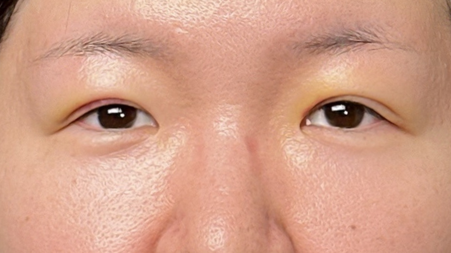 Postoperative Condition Part 1