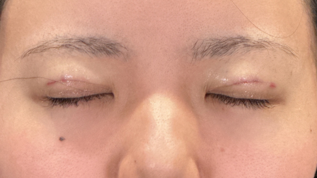 Postoperative Condition Part 1