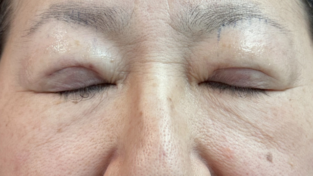 Postoperative Condition Part 1