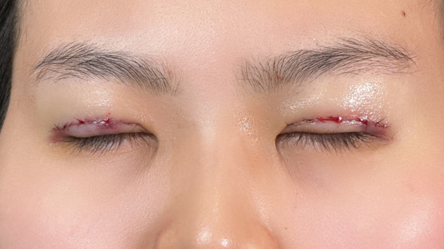 Postoperative Condition Part 1