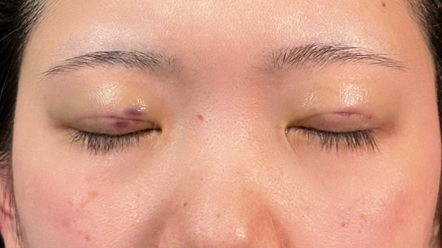 Postoperative Condition Part 1