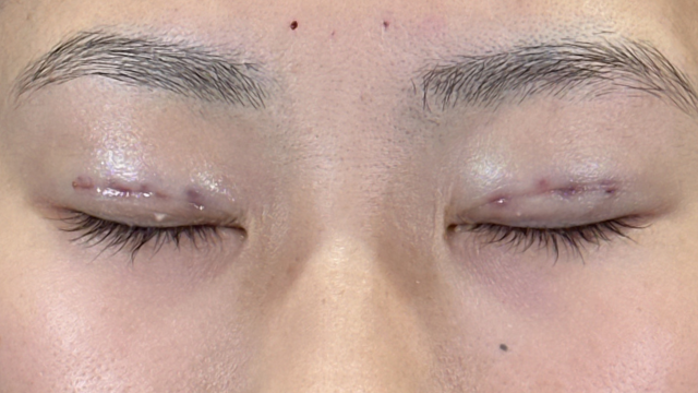 Postoperative Condition Part 1