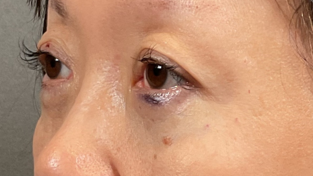 Postoperative Condition Part 1