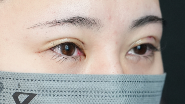 Postoperative Condition Part 1