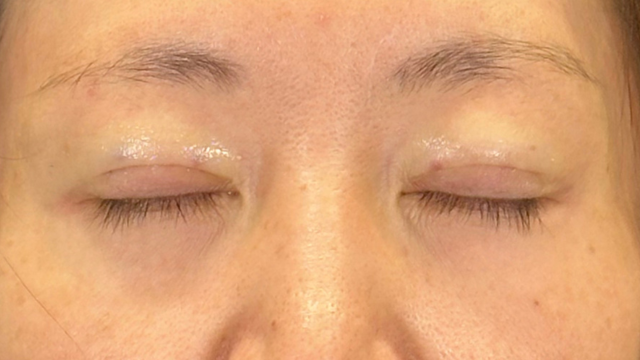 Postoperative Condition Part 1