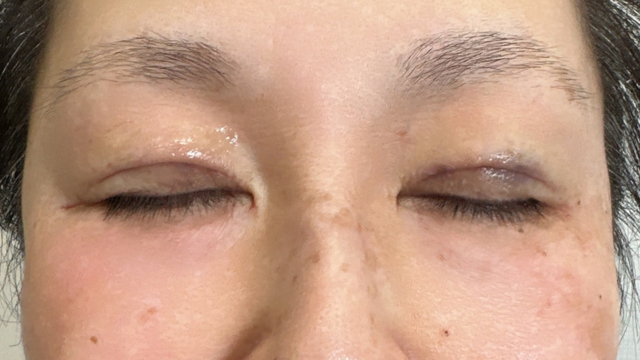 Postoperative Condition Part 1