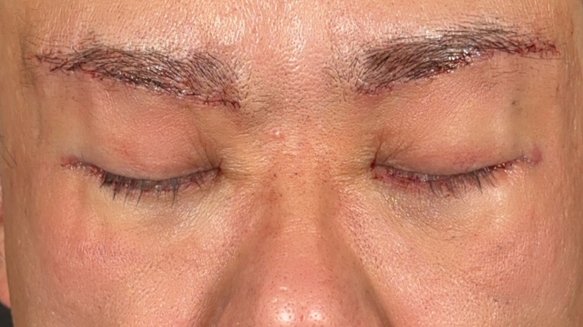 Postoperative Condition Part 1