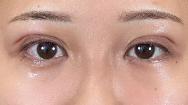 Postoperative Condition Part 1