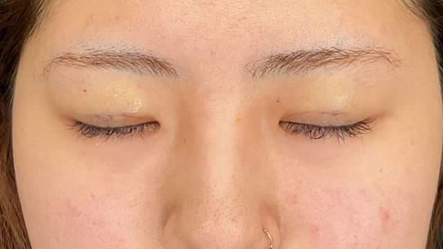 Postoperative Condition Part 1