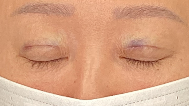 Postoperative Condition Part 1