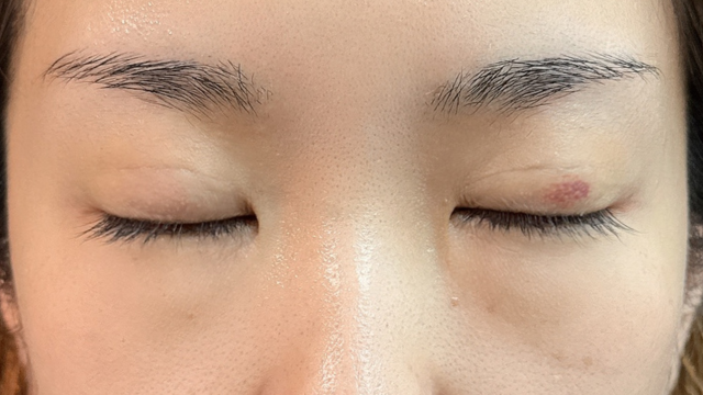 Postoperative Condition Part 1