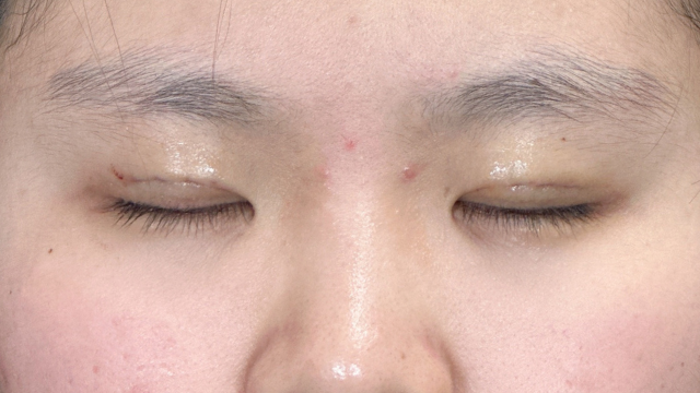 Postoperative Condition Part 1