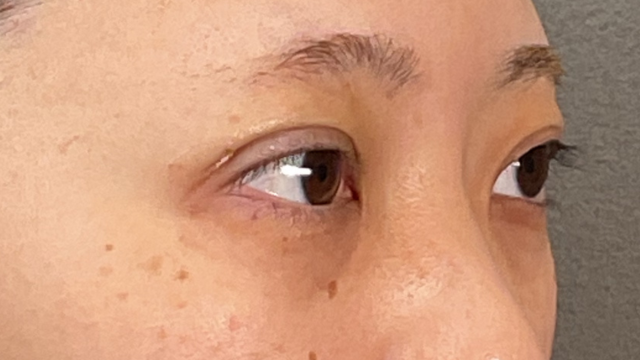 Postoperative Condition Part 1