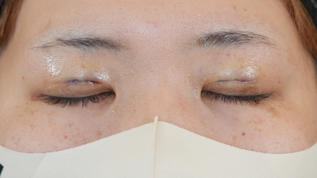 Postoperative Condition Part 1