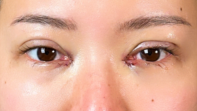 Postoperative Condition Part 1