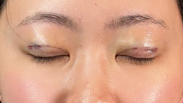 Postoperative Condition Part 1