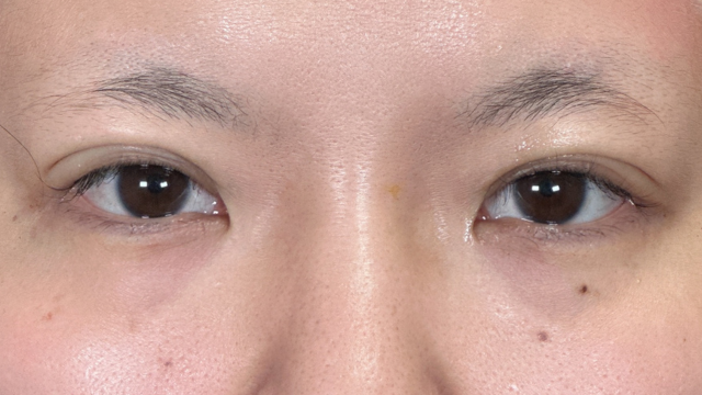 Postoperative Condition Part 1