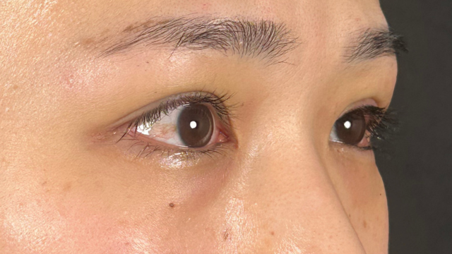 Postoperative Condition Part 1