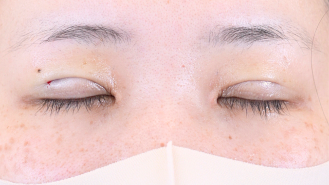 Postoperative Condition Part 1