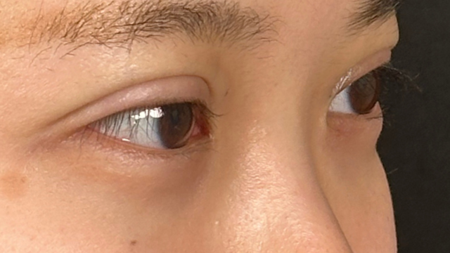 Postoperative Condition Part 1