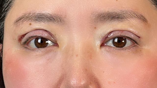 Postoperative Condition Part 1