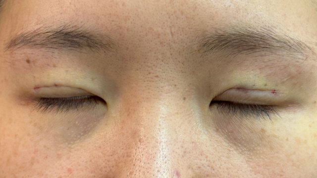 Postoperative Condition Part 1