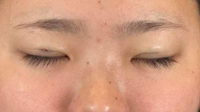 Postoperative Condition Part 1