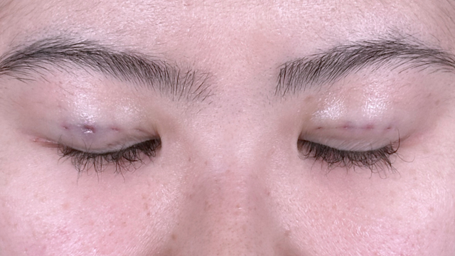 Postoperative Condition Part 1