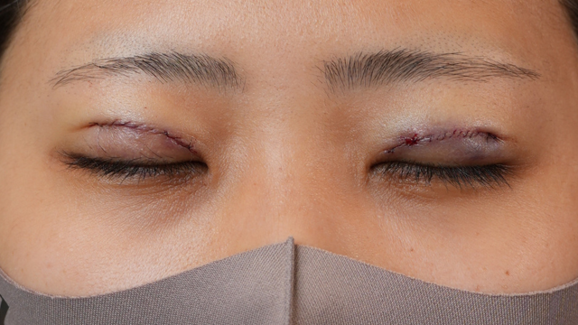 Postoperative Condition Part 1